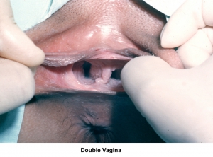 Woman with two vaginas hazel jones 960X712 jpeg