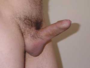 Penis foreskin phimosis 553X420 jpeg
