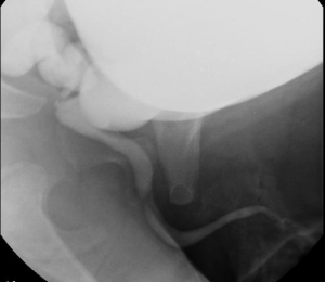 Prune belly urethra 572X497 jpeg