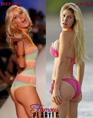 Heidi montag butt implants 407X514 jpeg