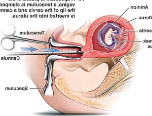 Pregnant bleeding after sex 546X418 jpeg