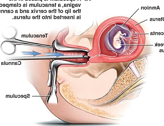 Pregnant bleeding after sex full size