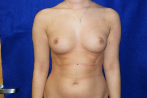 Transgender woman before and after surgery 852X568 jpeg