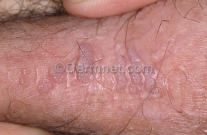 Early genital warts 720X471 jpeg
