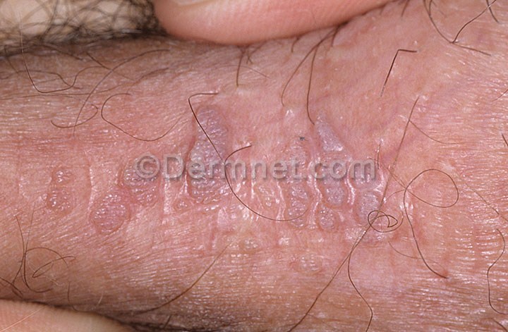 Early genital warts full size