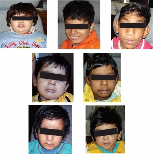 Prader willi angelman syndrome 960X966 jpeg