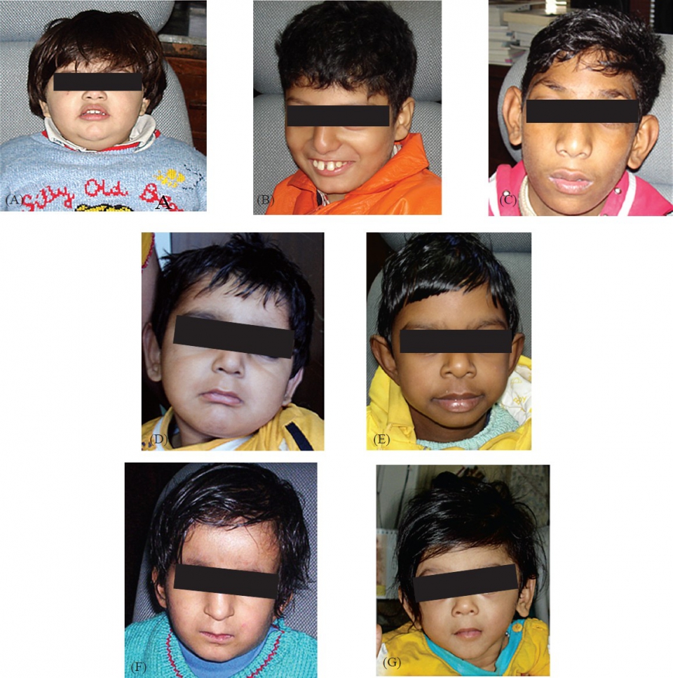 Prader willi angelman syndrome full size