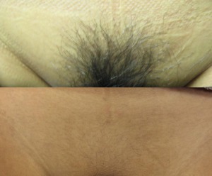 After before bikini area laser hair removal 734X608 jpeg