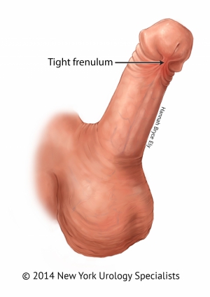 Tight frenulum penis 960X1357 jpeg