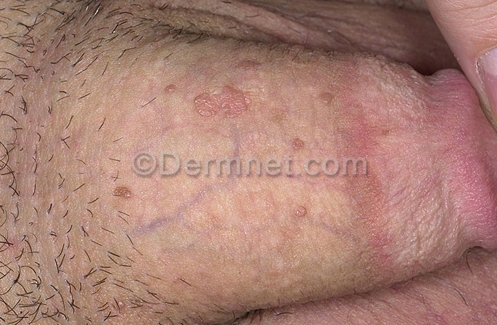 Genital warts full size