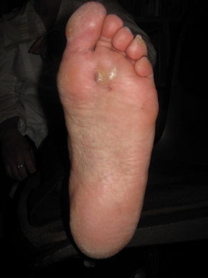 Hpv plantar warts on feet 960X1280 jpeg