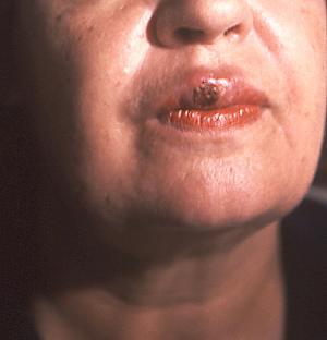 Syphilis chancre sore 700X728 jpeg