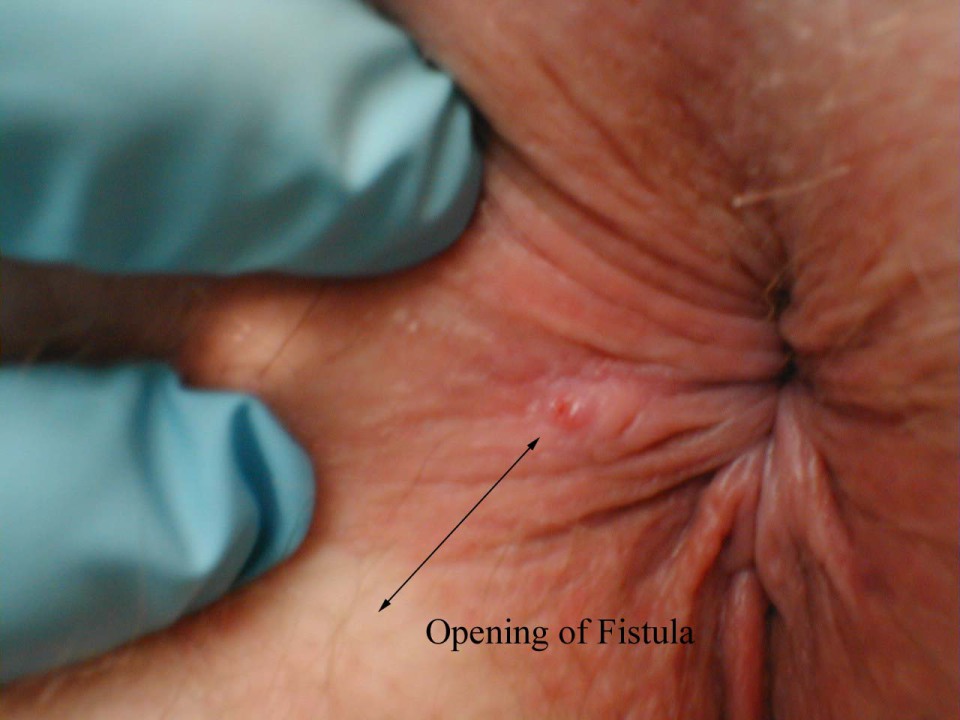 Anal fistula surgery full size