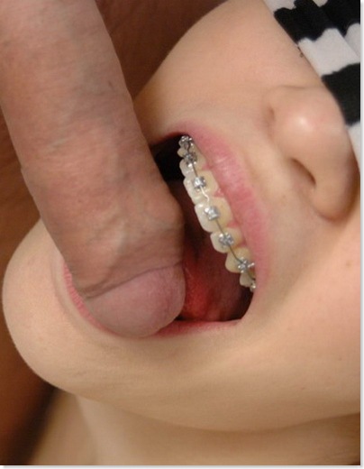Teen girls with braces full size