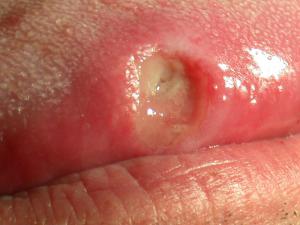 Mouth ulcer canker sores 800X600 jpeg