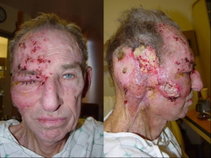 Genital herpes on men 960X720 jpeg