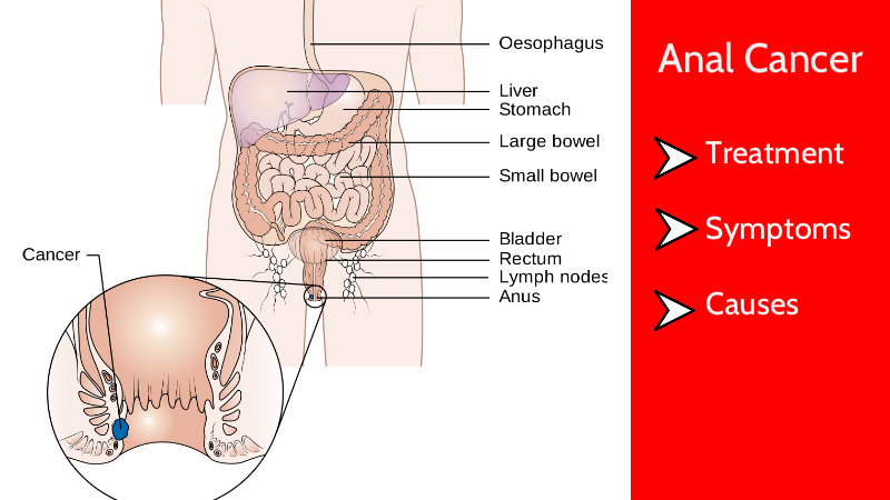 Anal cancer symptoms full size