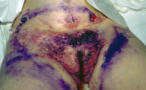 Hiv aids symptoms 722X446 jpeg
