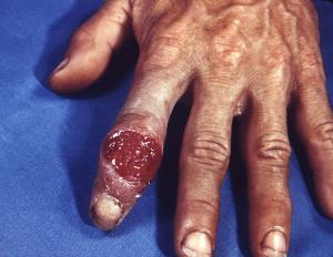 Syphilis chancre 773X600 jpeg
