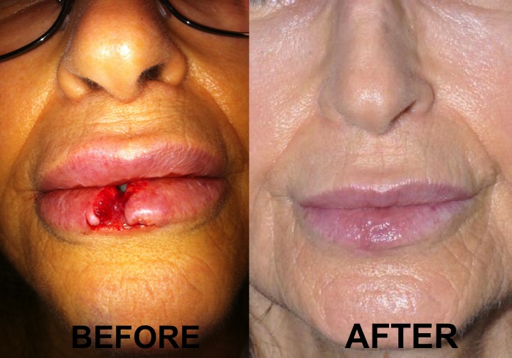 Facial reconstruction before and after full size