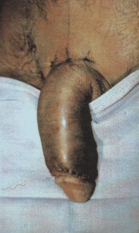 Penis girth enlargement surgery full size