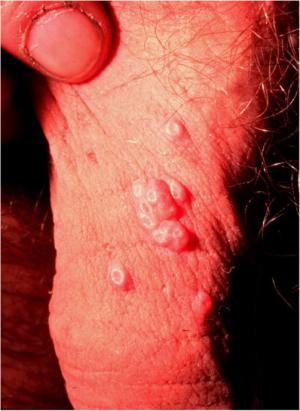 Eczema on penis 502X689 jpeg
