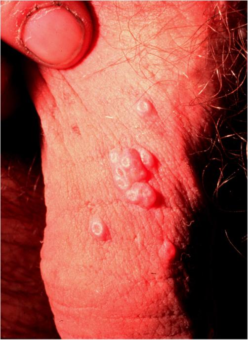 Eczema on penis full size