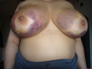 Big bruised tits boobs 960X720 jpeg