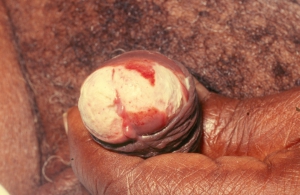 Std on penis head 960X626 jpeg