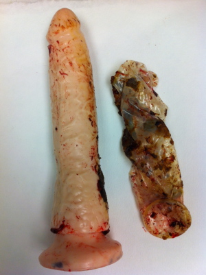 Foreign objects in rectum 960X1286 jpeg