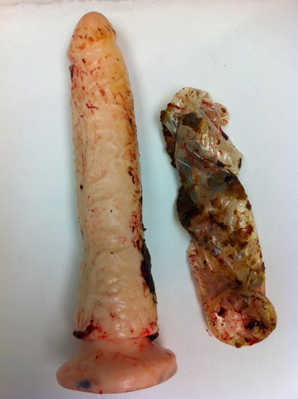 Foreign objects in rectum full size