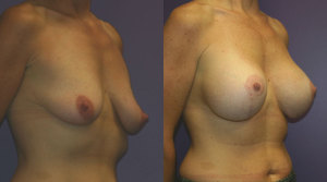 Gummy bear breast implants 850X475 jpeg