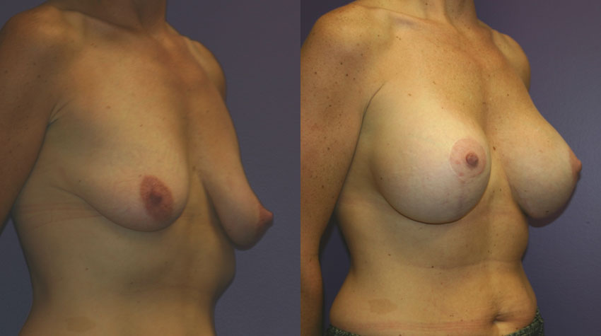 Gummy bear breast implants full size