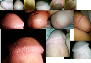 Small bumps on head of penis 640X445 jpeg