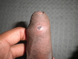 Sore on penis after sex 640X480 jpeg