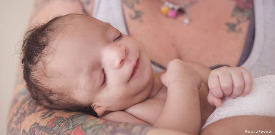 Babies with treacher collins syndrome full size