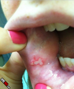 Canker sore 533X643 jpeg