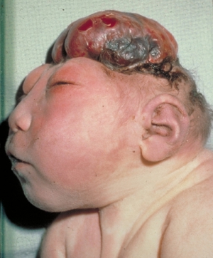 Pictures of babies with birth defect anencephaly 414X500 jpeg