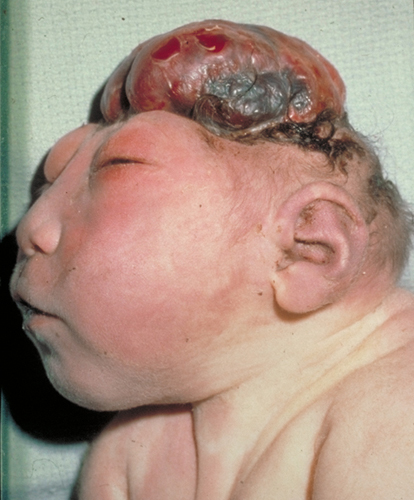 Pictures of babies with birth defect anencephaly full size
