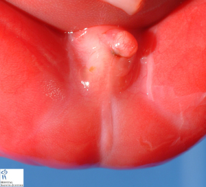 Anal atresia imperforate anus 960X874 jpeg