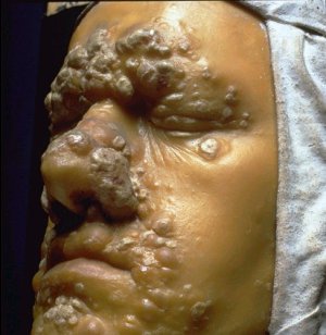 Syphilis symptoms 488X502 jpeg