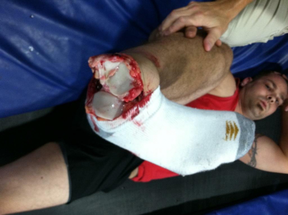 Worst injuries ever full size