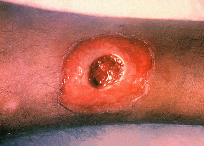Diphtheria skin lesion full size