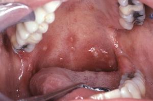 Hiv symptoms mouth sores 700X466 jpeg