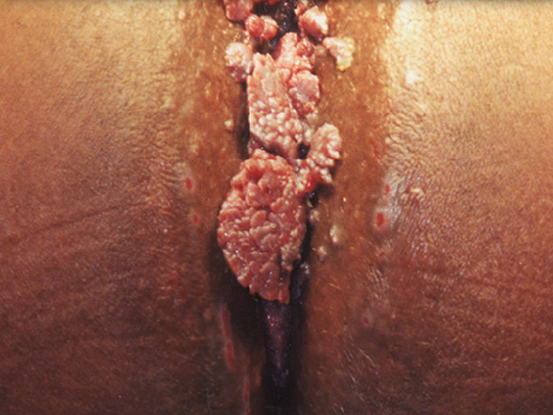 Hpv anal cancer full size