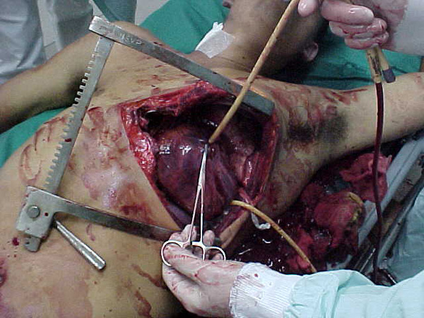 Penetrating chest trauma full size