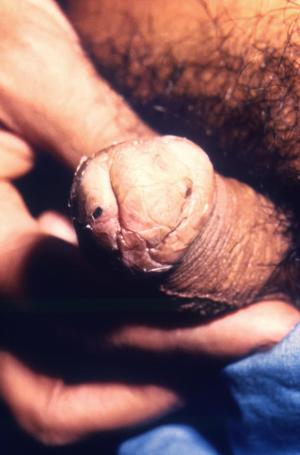 Genital warts on glans penis 700X1063 jpeg