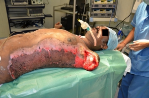 High voltage electrical injuries 960X635 jpeg