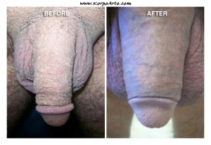 Penis enlargement surgery before after 620X428 jpeg