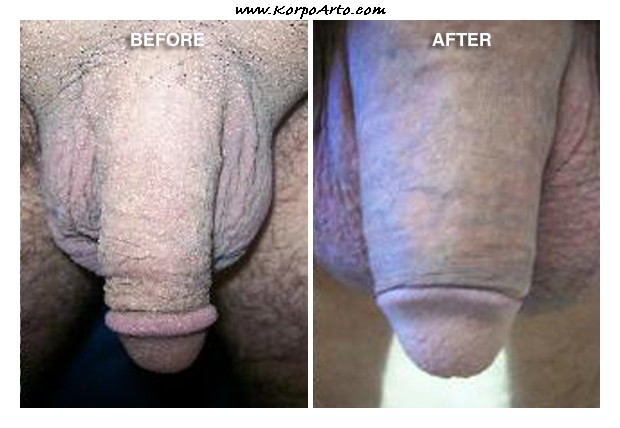 Penis enlargement surgery before after full size